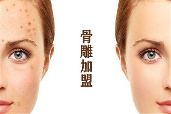 骨雕美容加盟