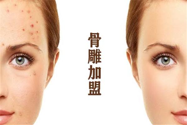 骨雕美容加盟