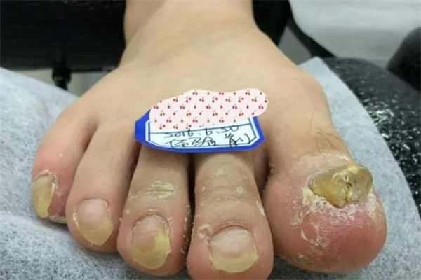 膚甲益生灰指甲