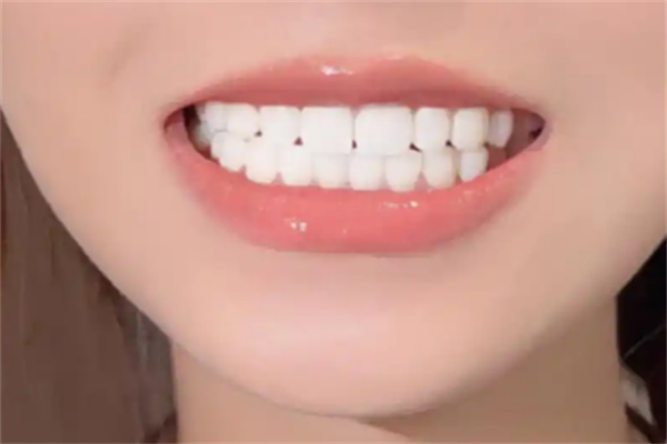 玉蘭貴人美牙